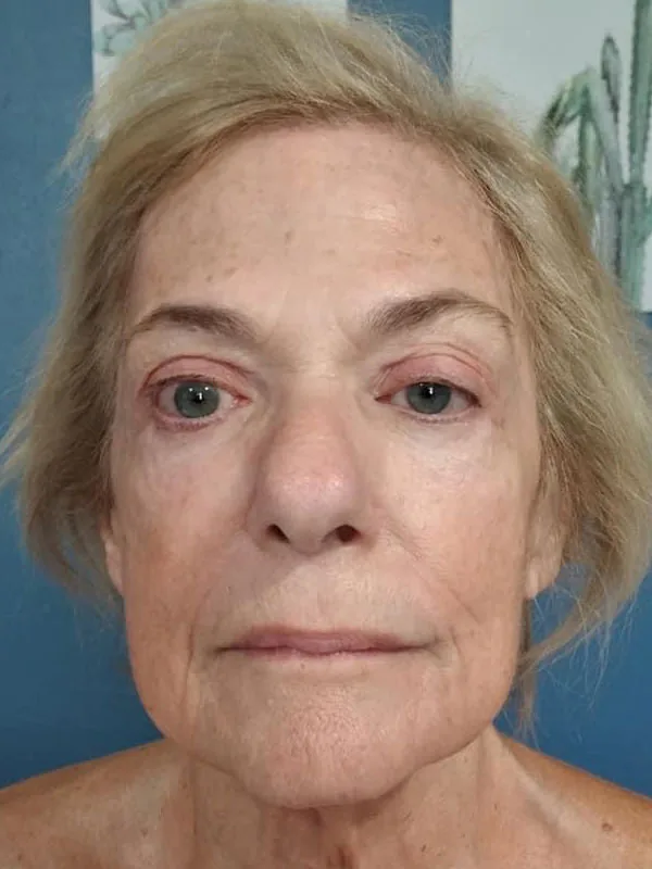 Lymphatic Facial Rejuvenation MLD 3 - Image 7